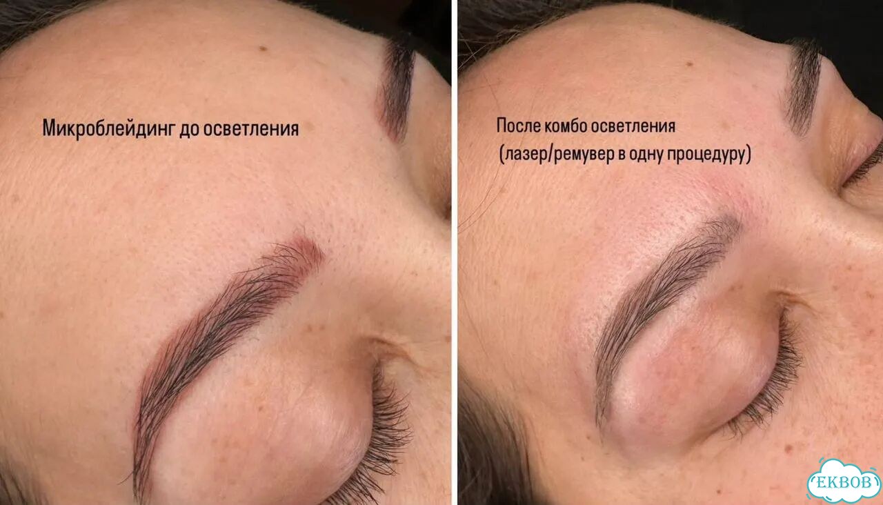 Удаление перманентного макияжа фото 2