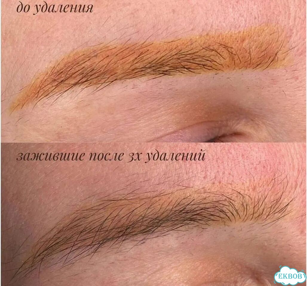 Удаление перманентного макияжа фото 4