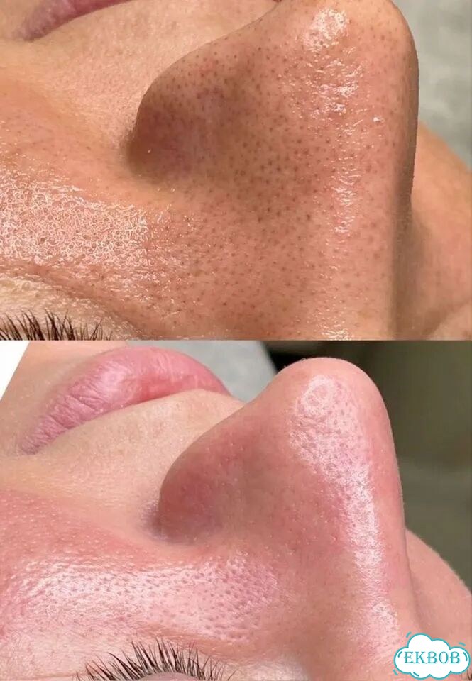 Чистка лица + микронидлинг фото 4