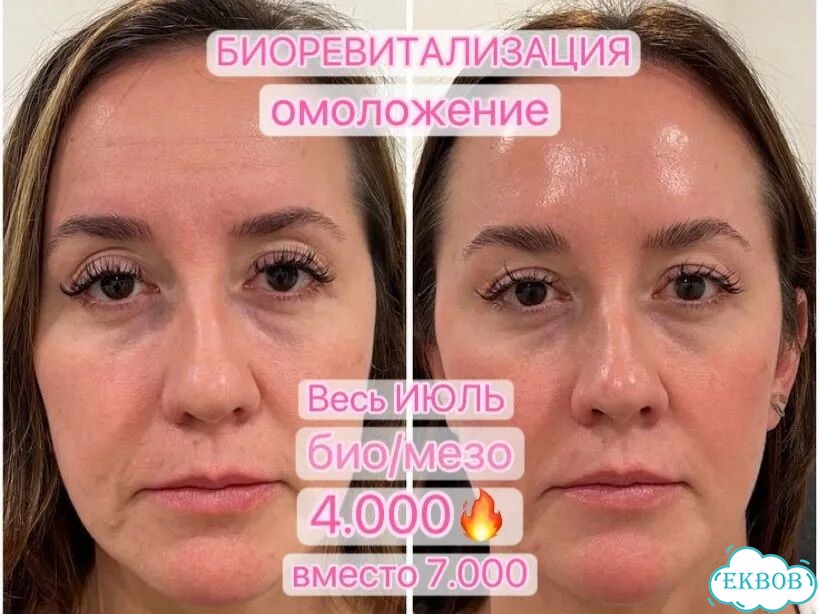 Биоревитализация мезотерапия фото 1