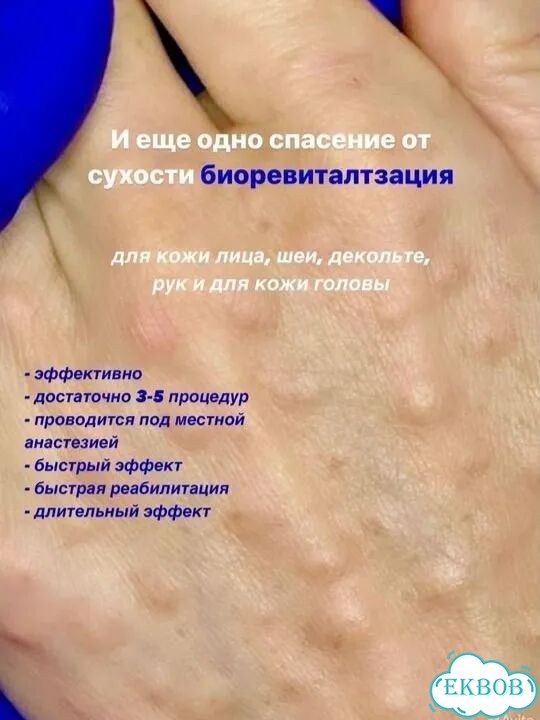 Биоревитализация мезотерапия фото 6